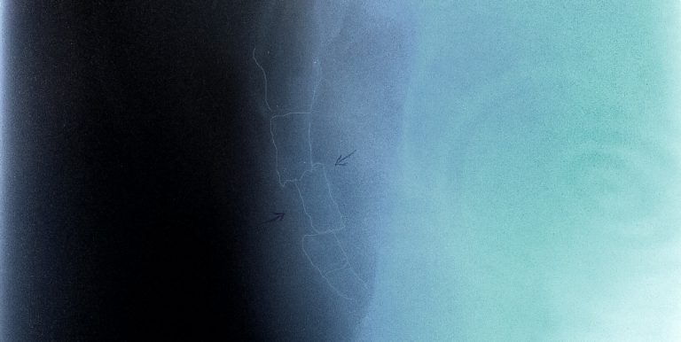 Zlomená kostrč - rentgen